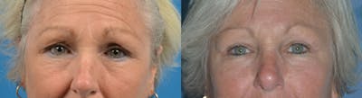 Eyelid Surgery Before & After Gallery - Patient 122405695 - Image 1