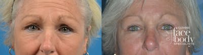 Eyelid Surgery Before & After Gallery - Patient 113737 - Image 1
