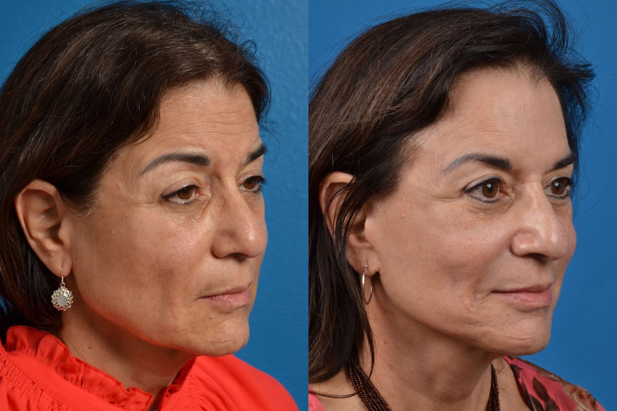 Facelift Before & After Gallery - Patient 122405694 - Image 4