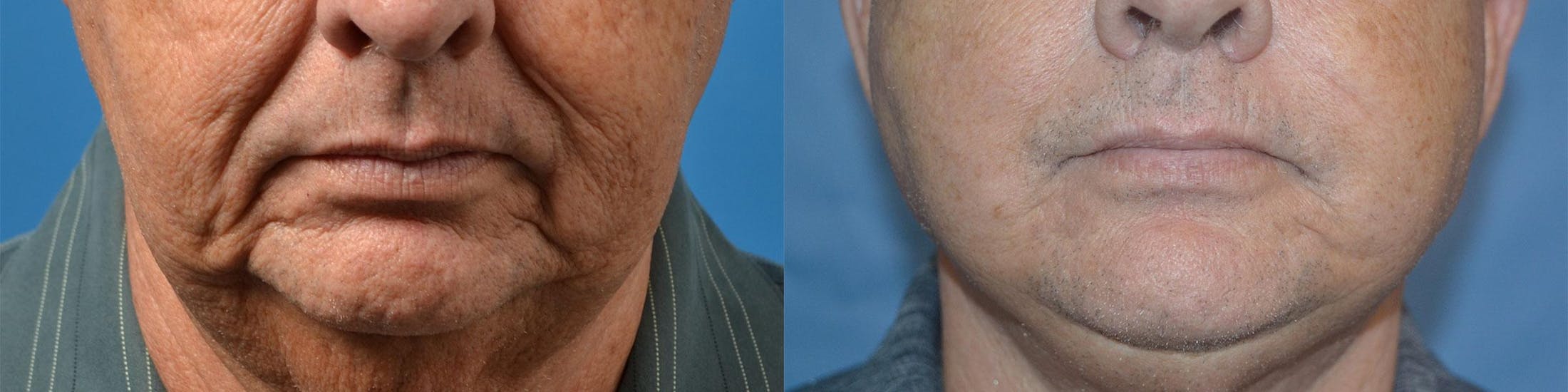 Dermal Fillers Before & After Gallery - Patient 122405693 - Image 1
