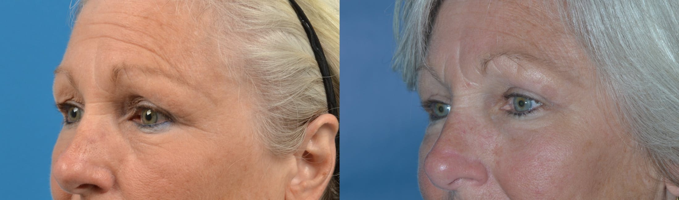 Eyelid Surgery Before & After Gallery - Patient 122405695 - Image 2