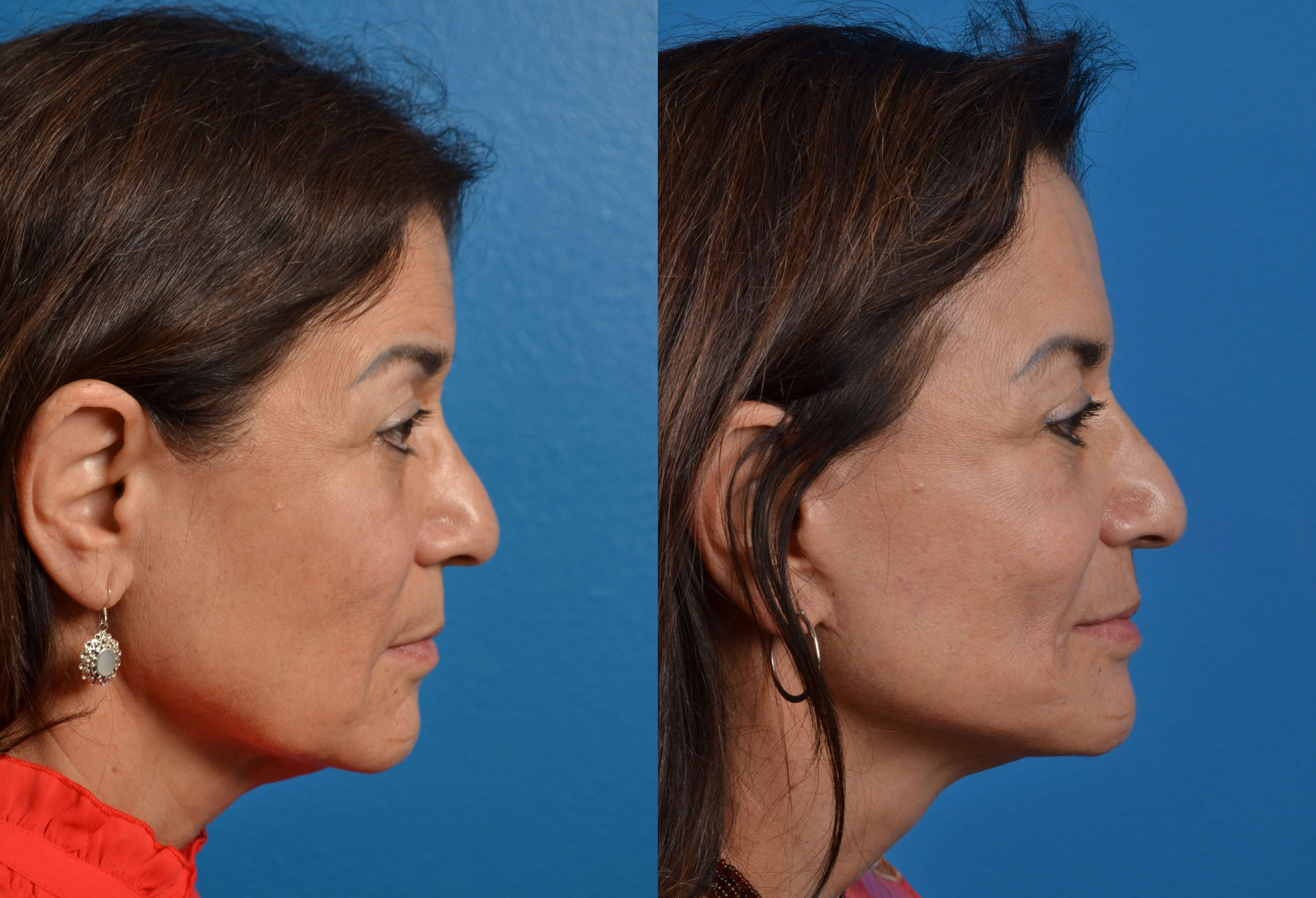 Facelift Before & After Gallery - Patient 122405694 - Image 5