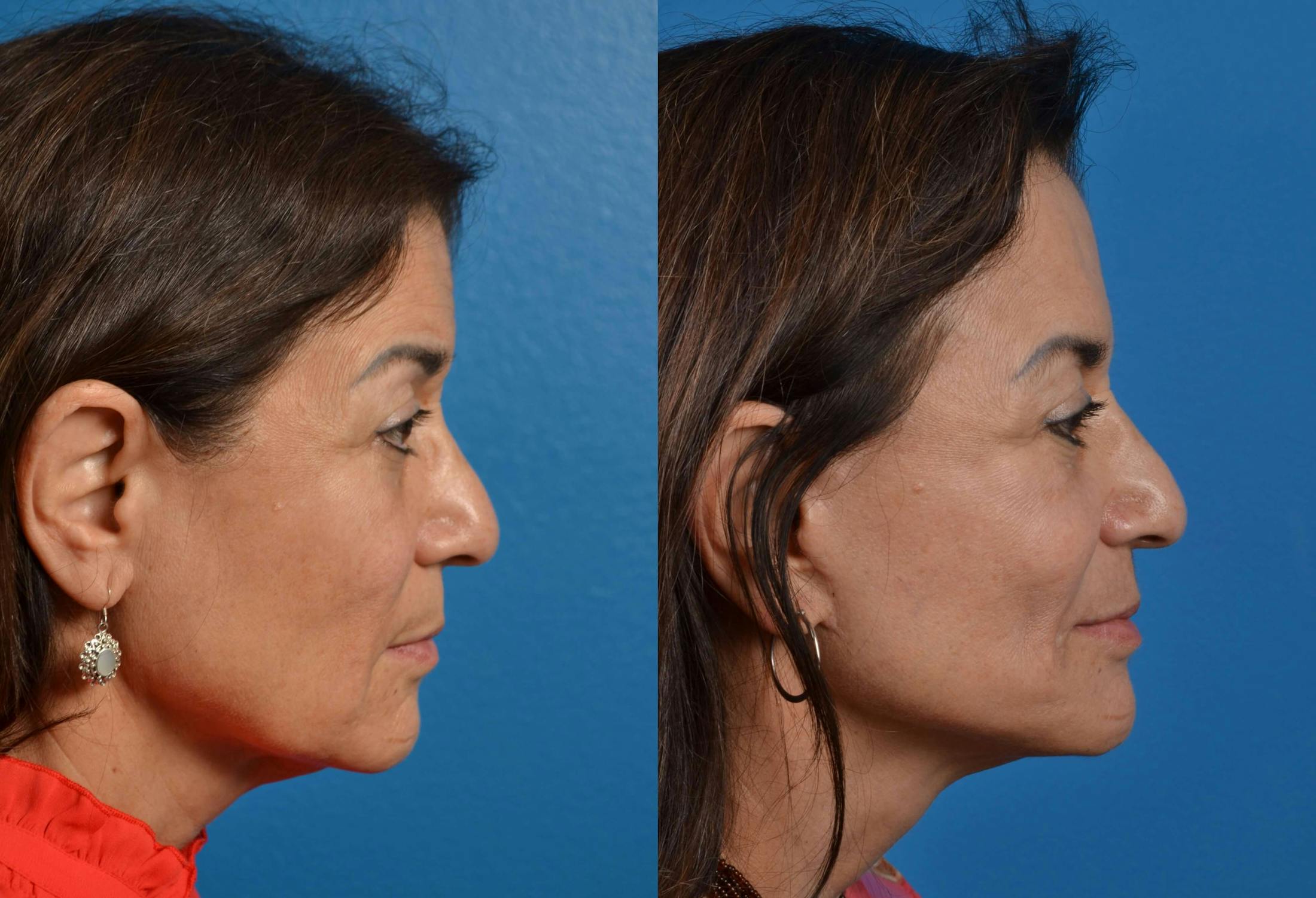 Facelift Before & After Gallery - Patient 122405694 - Image 5