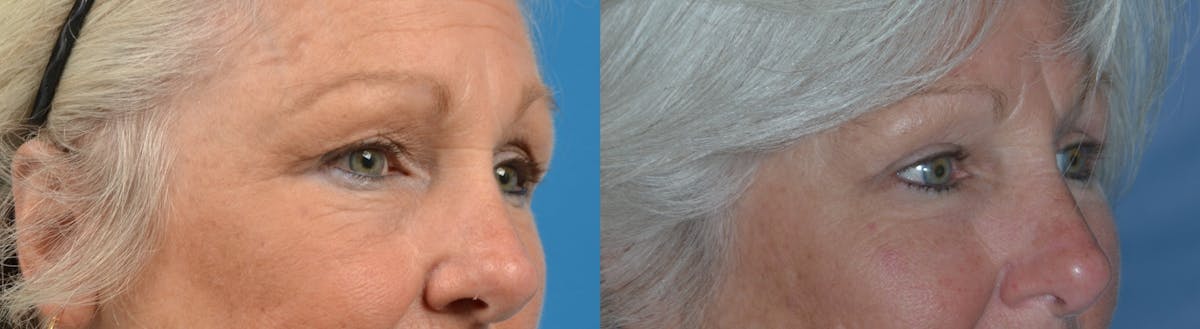 Eyelid Surgery Before & After Gallery - Patient 122405695 - Image 3