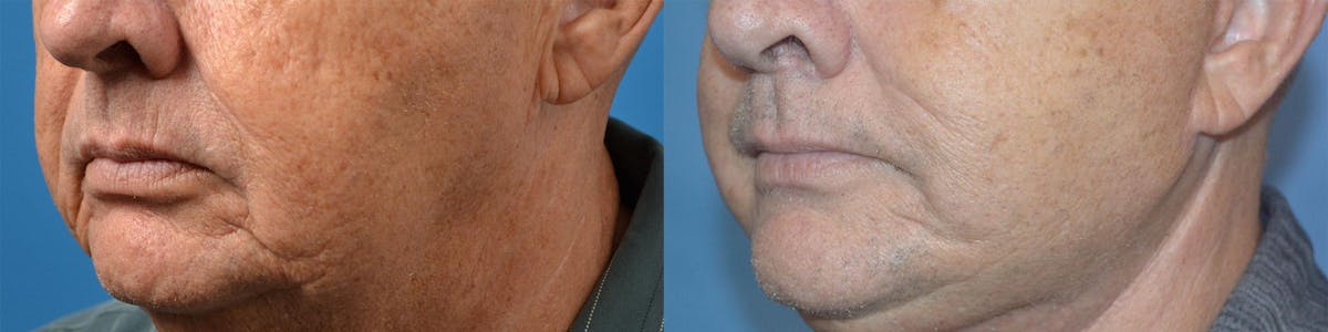 Dermal Fillers Before & After Gallery - Patient 122405693 - Image 3