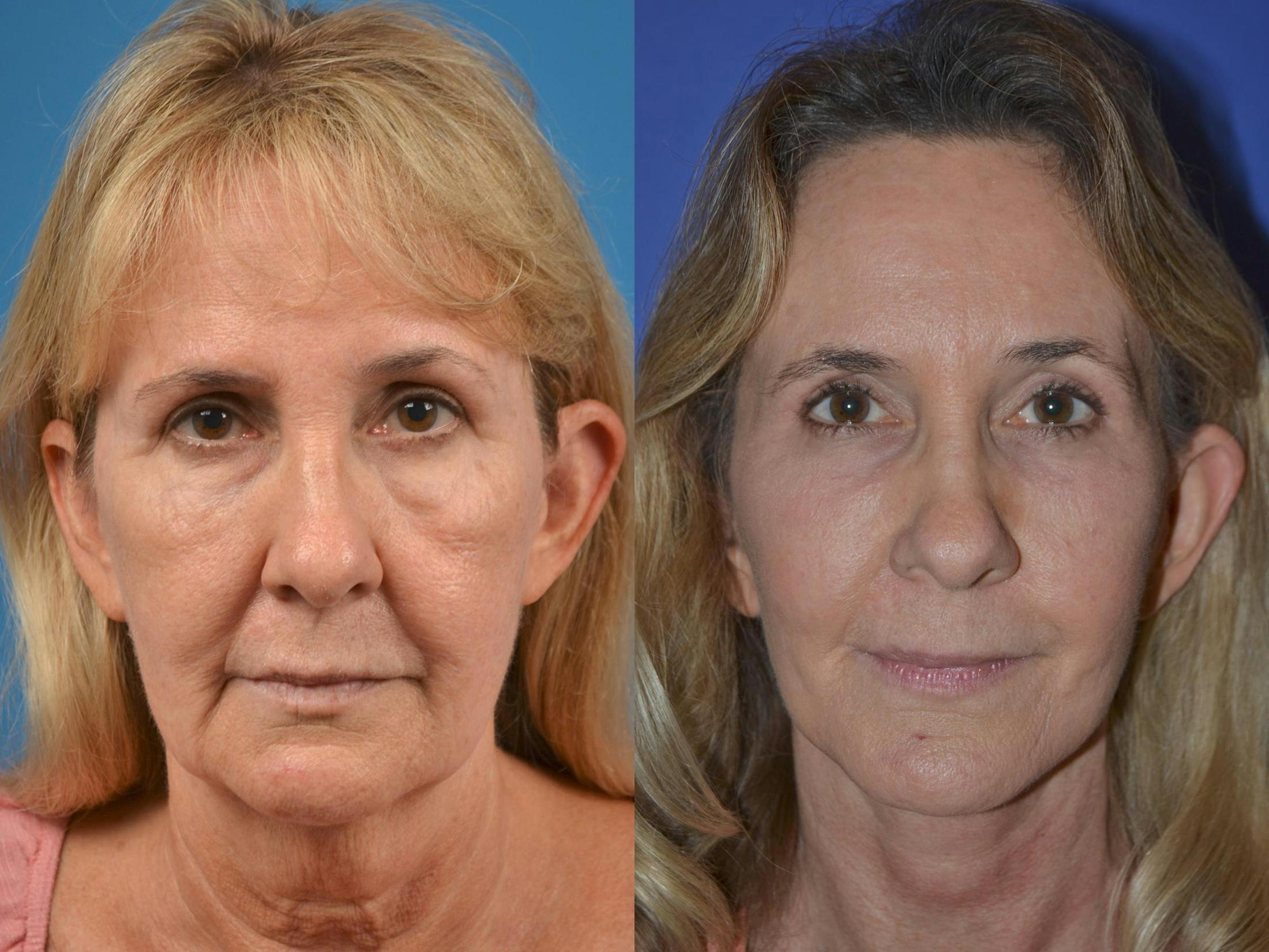 Dermal Fillers Before & After Gallery - Patient 122405696 - Image 1