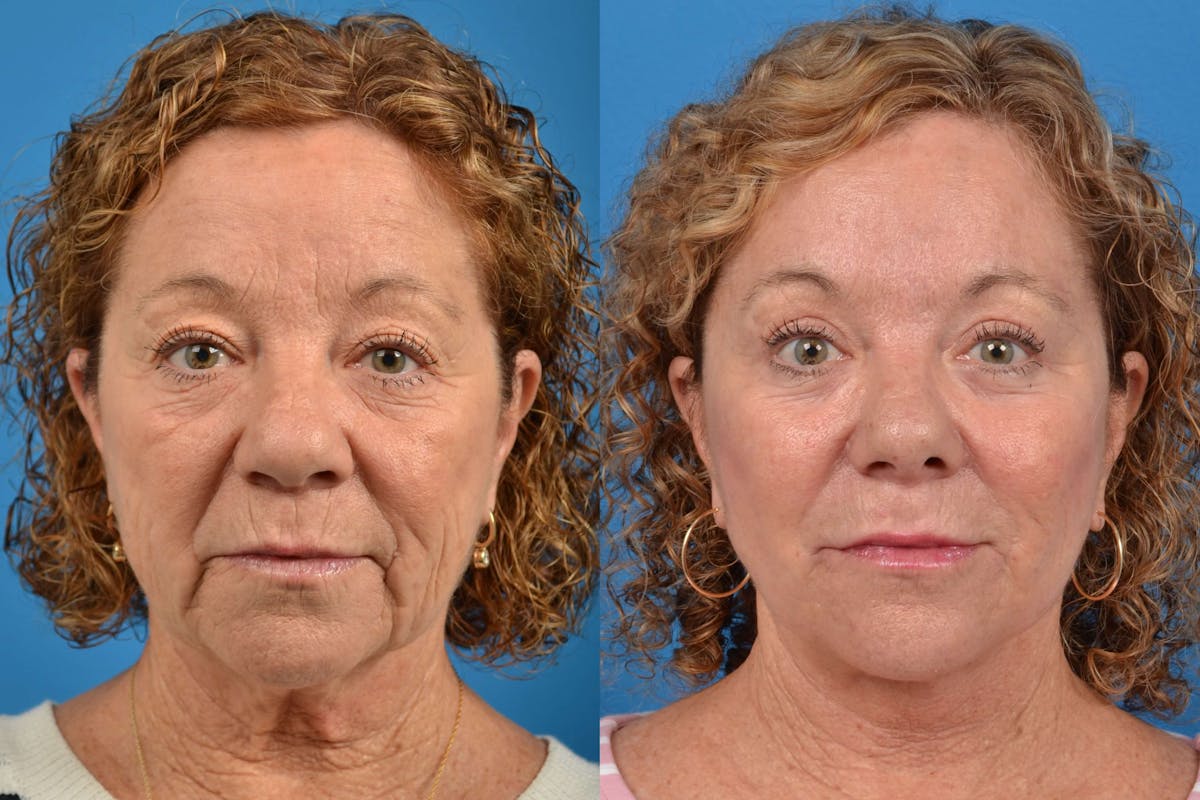 Facelift Before & After Gallery - Patient 122405701 - Image 1