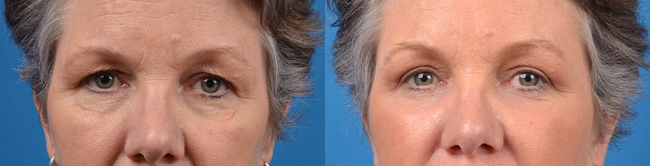 Eyelid Surgery Before & After Gallery - Patient 122405699 - Image 1