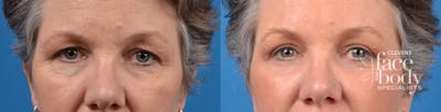 Eyelid Surgery Before & After Gallery - Patient 256101 - Image 1