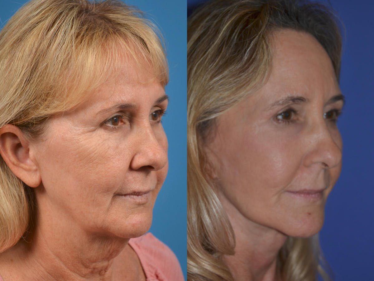 Dermal Fillers Before & After Gallery - Patient 122405696 - Image 2