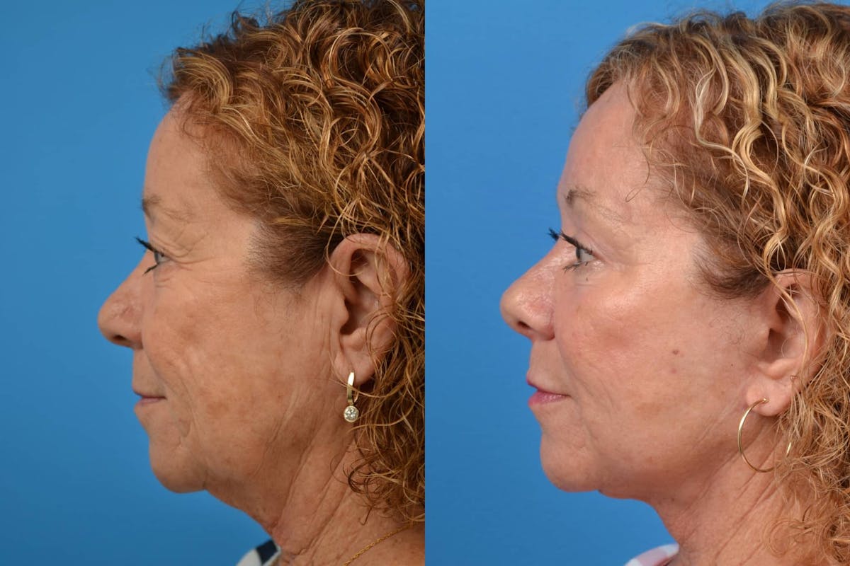 Facelift Before & After Gallery - Patient 122405701 - Image 2
