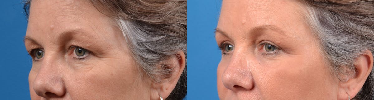 Eyelid Surgery Before & After Gallery - Patient 122405699 - Image 2