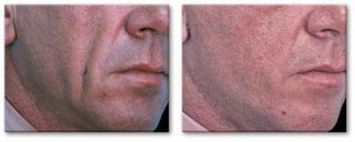 Dermal Fillers Before & After Gallery - Patient 122405697 - Image 1