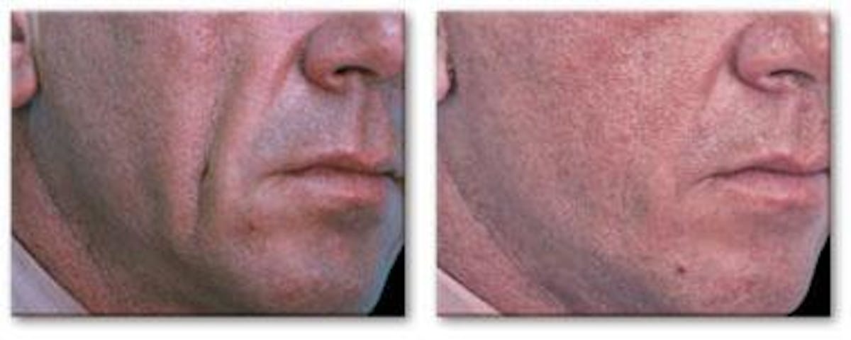 Dermal Fillers Before & After Gallery - Patient 122405697 - Image 1
