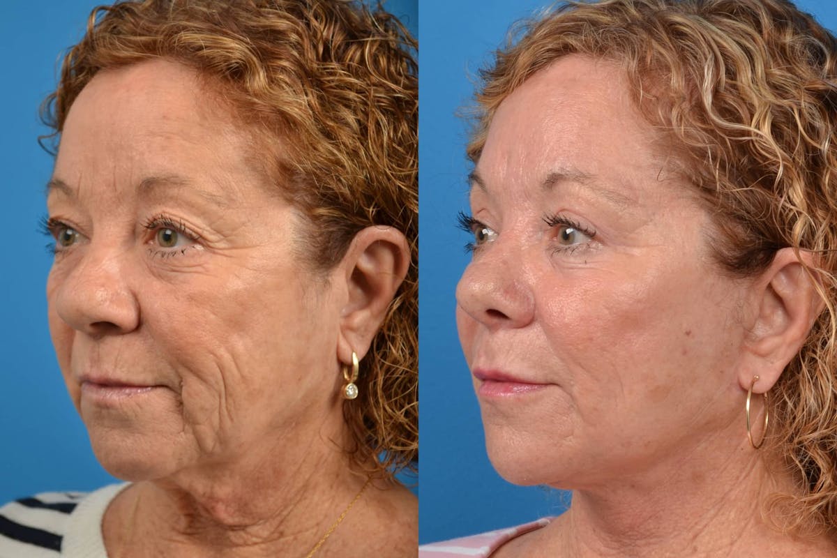 Facelift Before & After Gallery - Patient 122405701 - Image 3