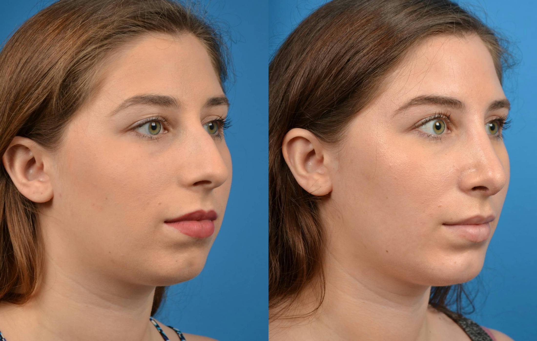 Facial Implant Before & After Gallery - Patient 122405700 - Image 4