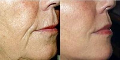 Dermal Fillers Before & After Gallery - Patient 122405698 - Image 1