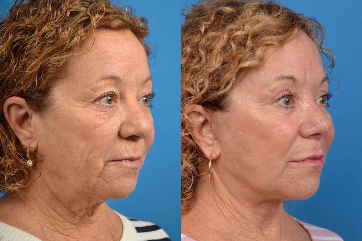 Facelift Before & After Gallery - Patient 122405701 - Image 4
