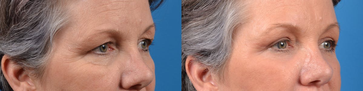 Eyelid Surgery Before & After Gallery - Patient 122405699 - Image 3