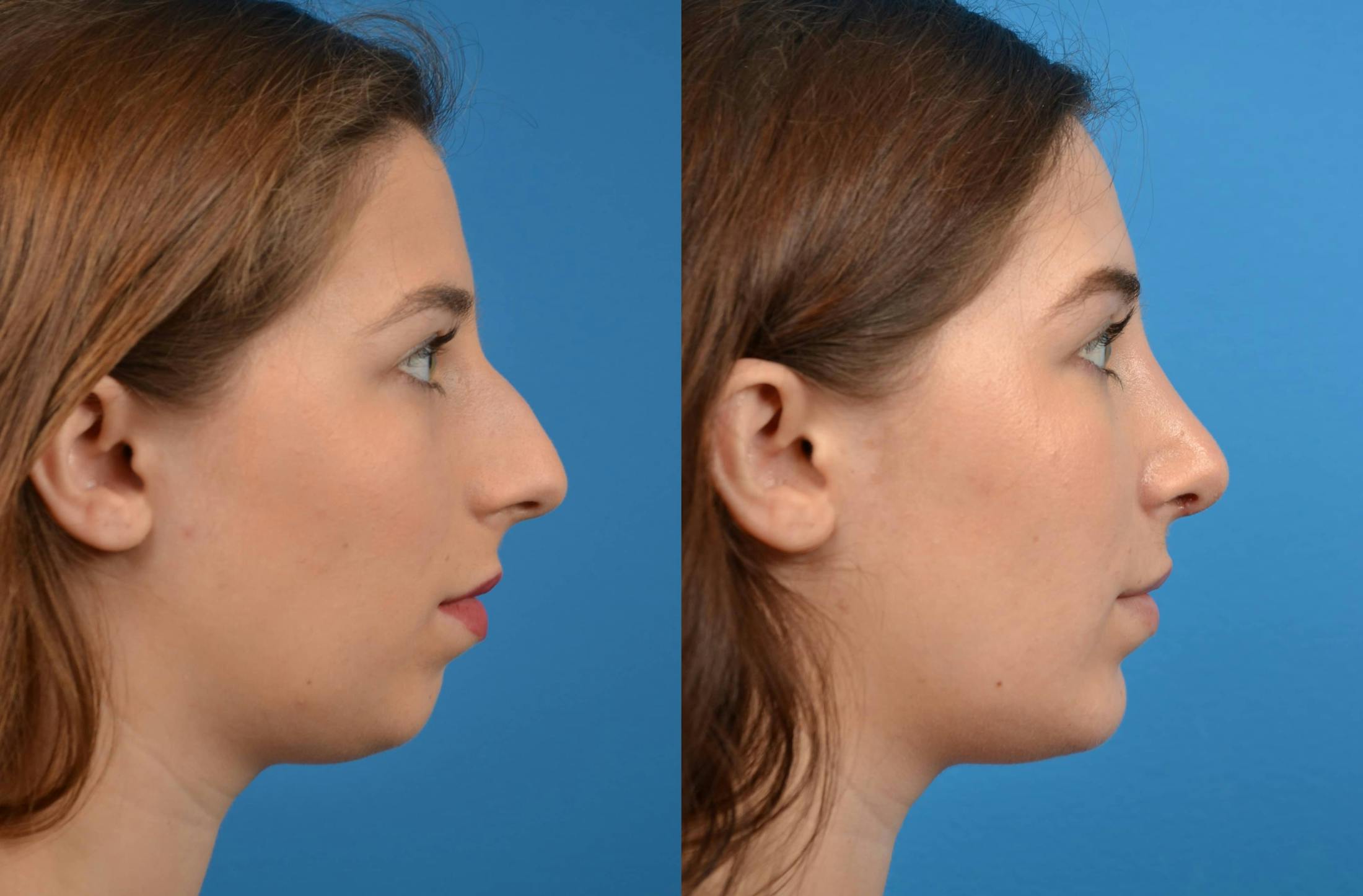Facial Implant Before & After Gallery - Patient 122405700 - Image 5
