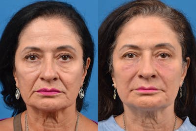 Dermal Fillers Before & After Gallery - Patient 122405709 - Image 1