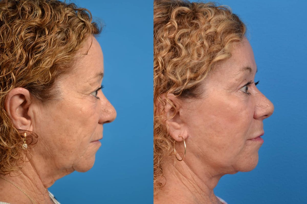 Facelift Before & After Gallery - Patient 122405701 - Image 5