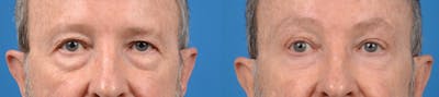 Eyelid Surgery Before & After Gallery - Patient 122405705 - Image 1