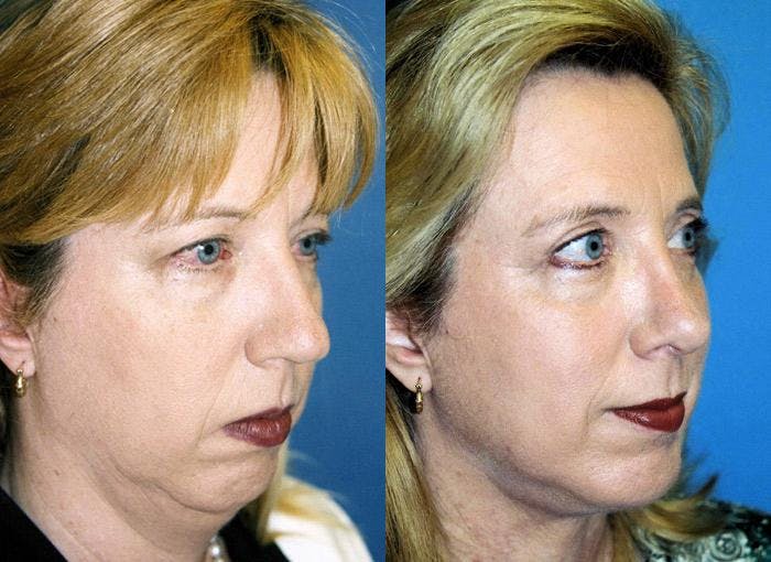 Facial Implant Before & After Gallery - Patient 122405702 - Image 1