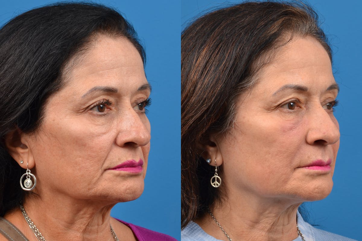 Dermal Fillers Before & After Gallery - Patient 122405709 - Image 2