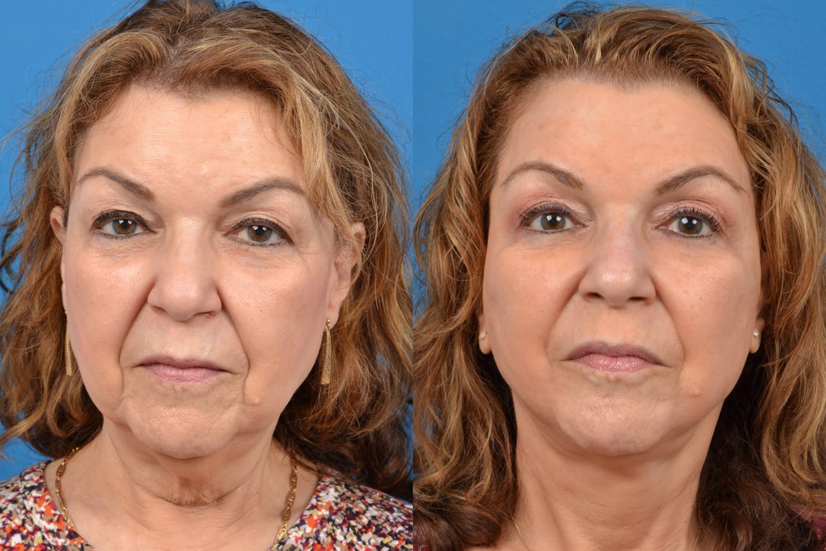 Facelift Before & After Gallery - Patient 122405713 - Image 1