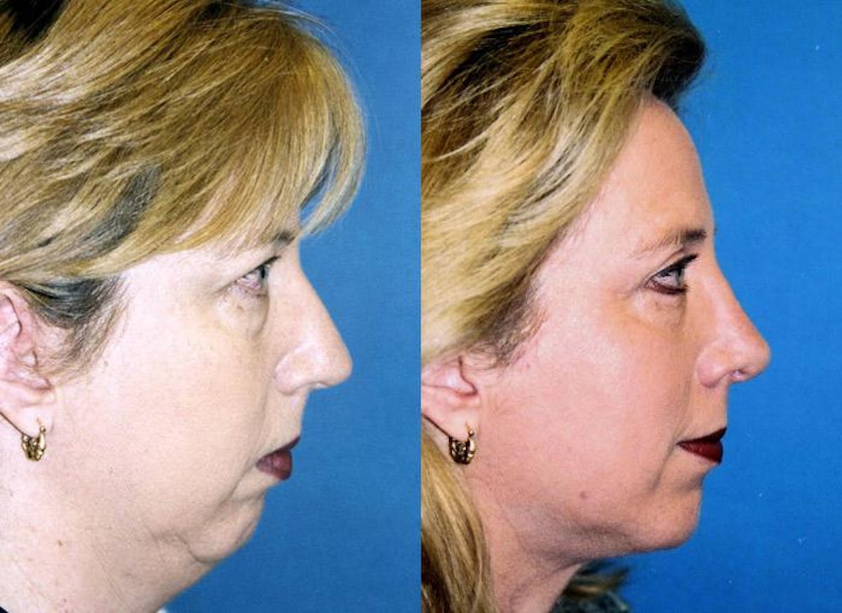 Facial Implant Before & After Gallery - Patient 122405702 - Image 2