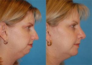 Facial Implant Before & After Gallery - Patient 122405703 - Image 1
