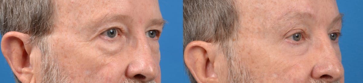 Eyelid Surgery Before & After Gallery - Patient 122405705 - Image 3