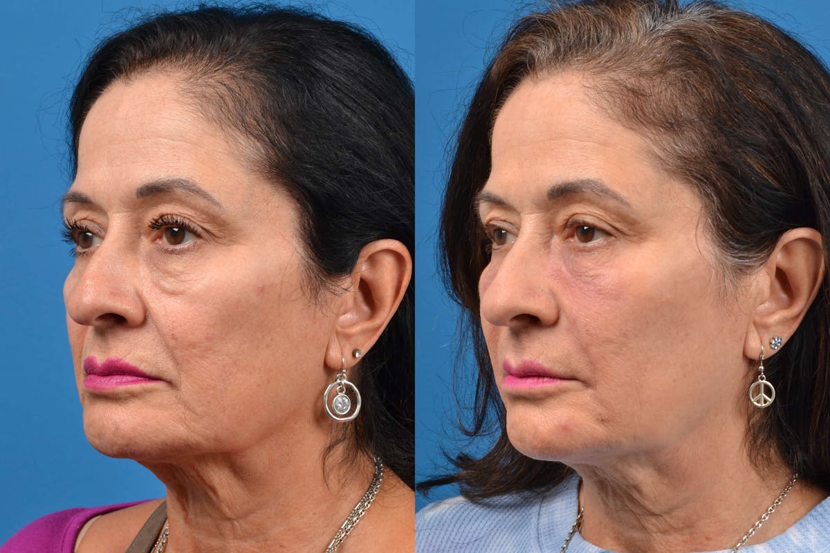 Dermal Fillers Before & After Gallery - Patient 122405709 - Image 3