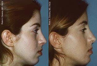 Facial Implant Before & After Gallery - Patient 122405704 - Image 1