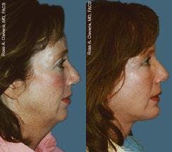 Facial Implant Before & After Gallery - Patient 122405706 - Image 1