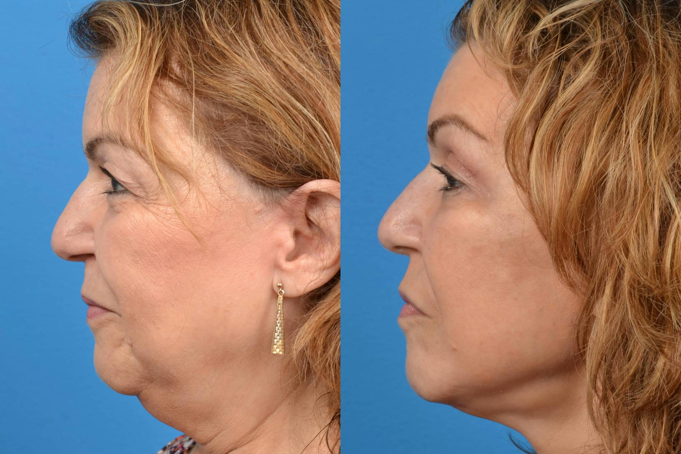 Facelift Before & After Gallery - Patient 122405713 - Image 2