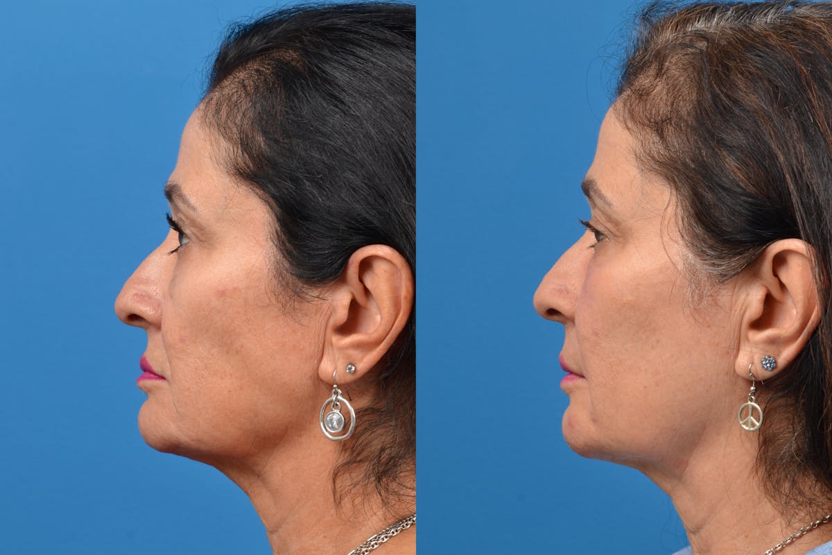 Dermal Fillers Before & After Gallery - Patient 122405709 - Image 4