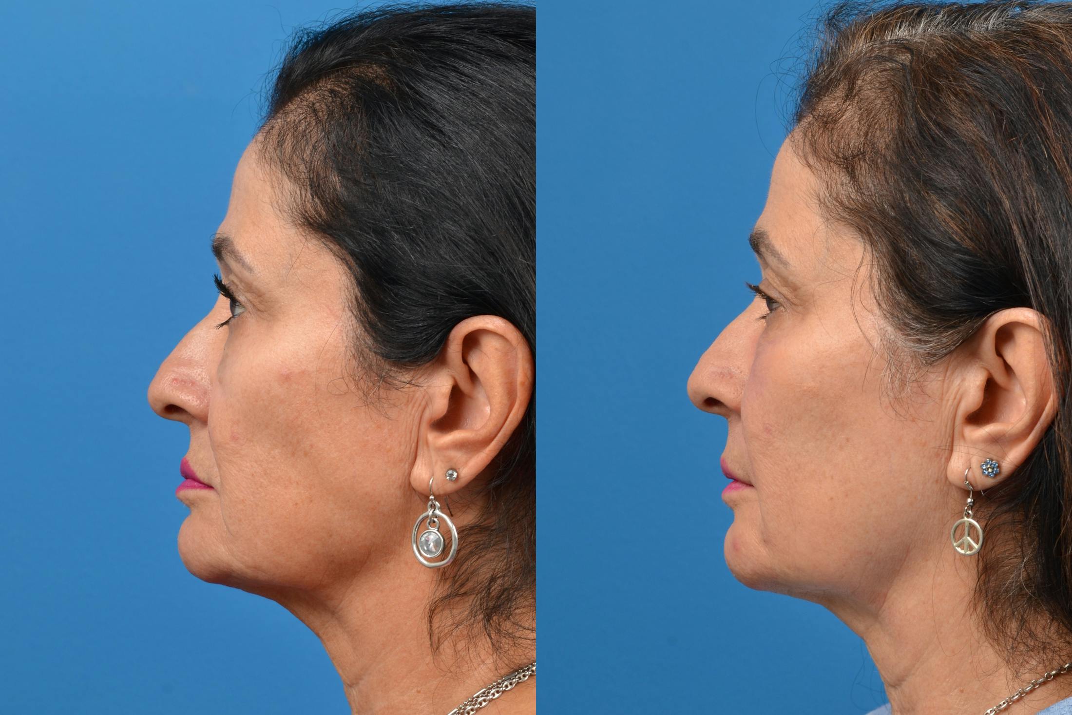 Dermal Fillers Before & After Gallery - Patient 122405709 - Image 4
