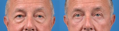 Eyelid Surgery Before & After Gallery - Patient 122405711 - Image 1