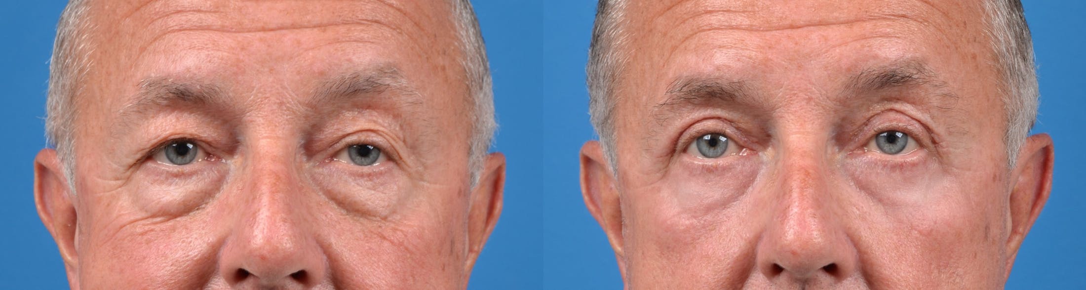 Eyelid Surgery Before & After Gallery - Patient 122405711 - Image 1