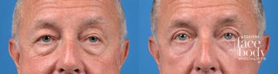 Eyelid Surgery Before & After Gallery - Patient 312219 - Image 1