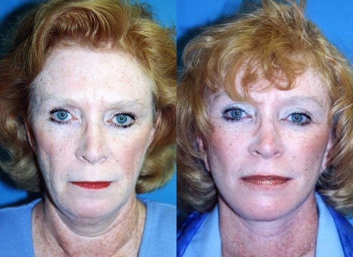 Facial Implant Before & After Gallery - Patient 122405707 - Image 1