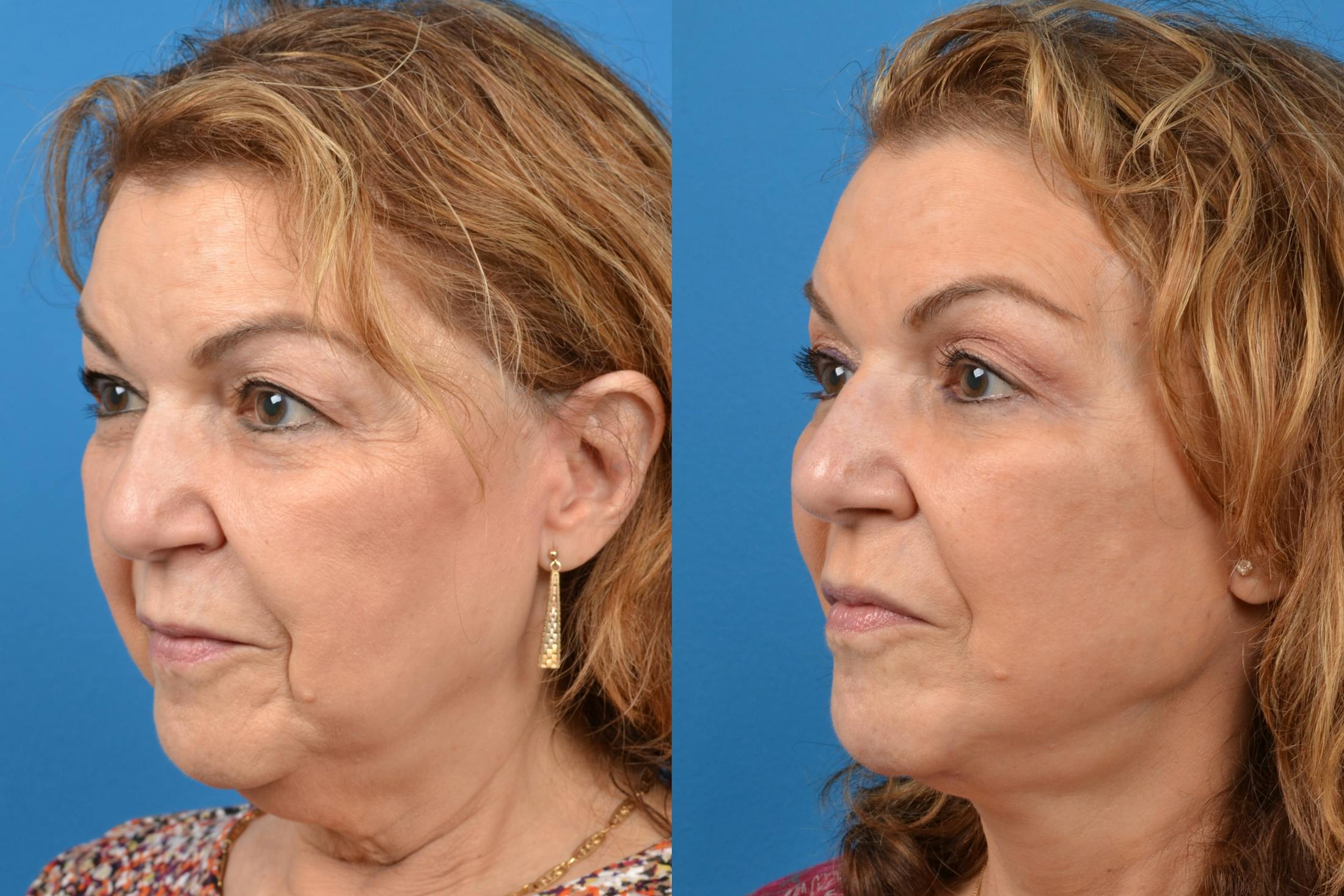 Facelift Before & After Gallery - Patient 122405713 - Image 3