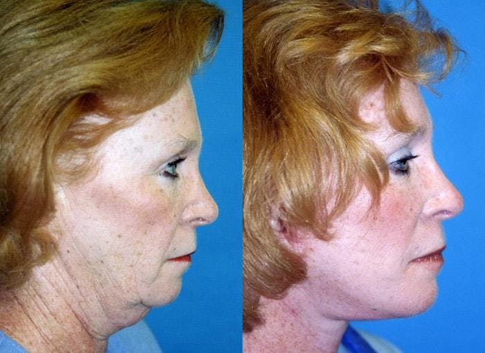 Facial Implant Before & After Gallery - Patient 122405707 - Image 2