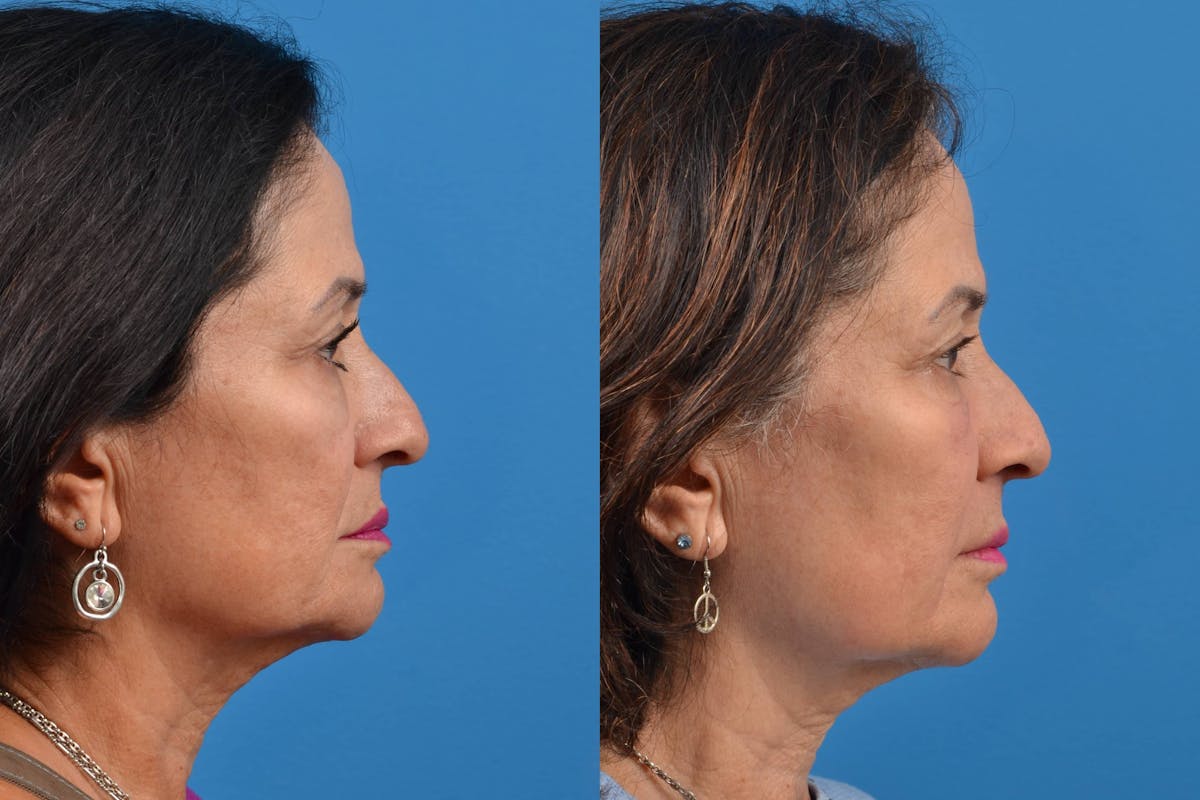 Dermal Fillers Before & After Gallery - Patient 122405709 - Image 5