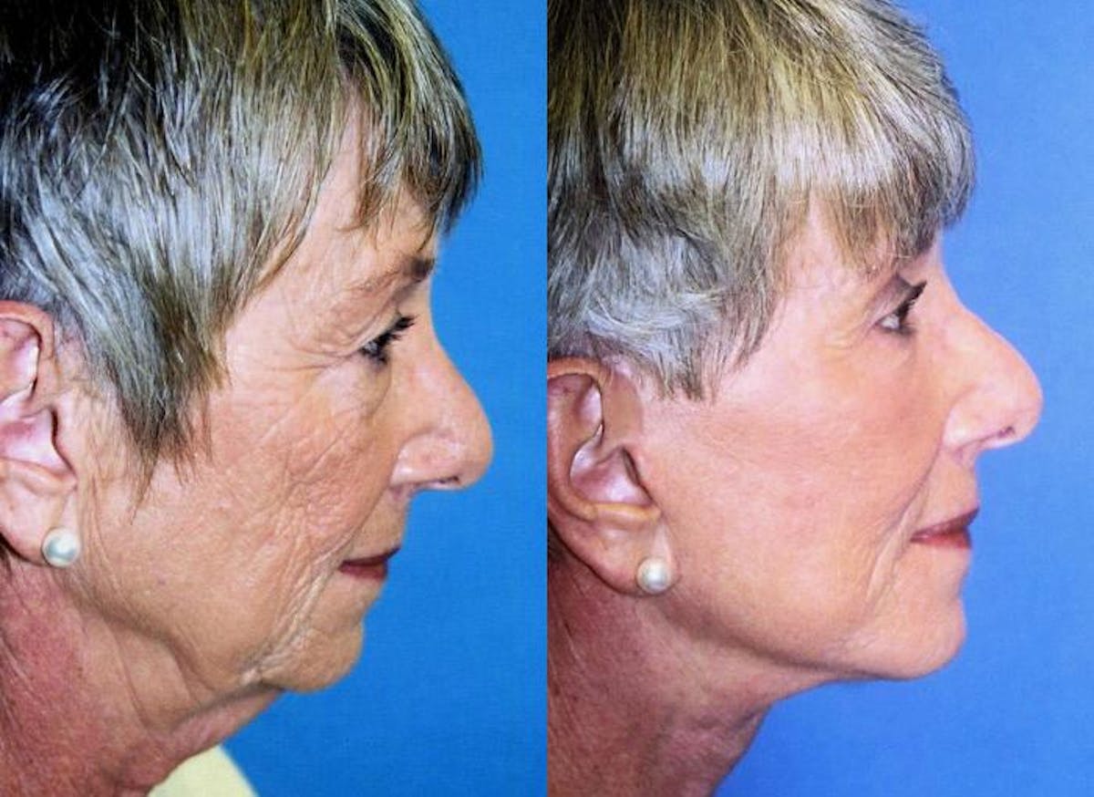Facial Implant Before & After Gallery - Patient 122405708 - Image 1