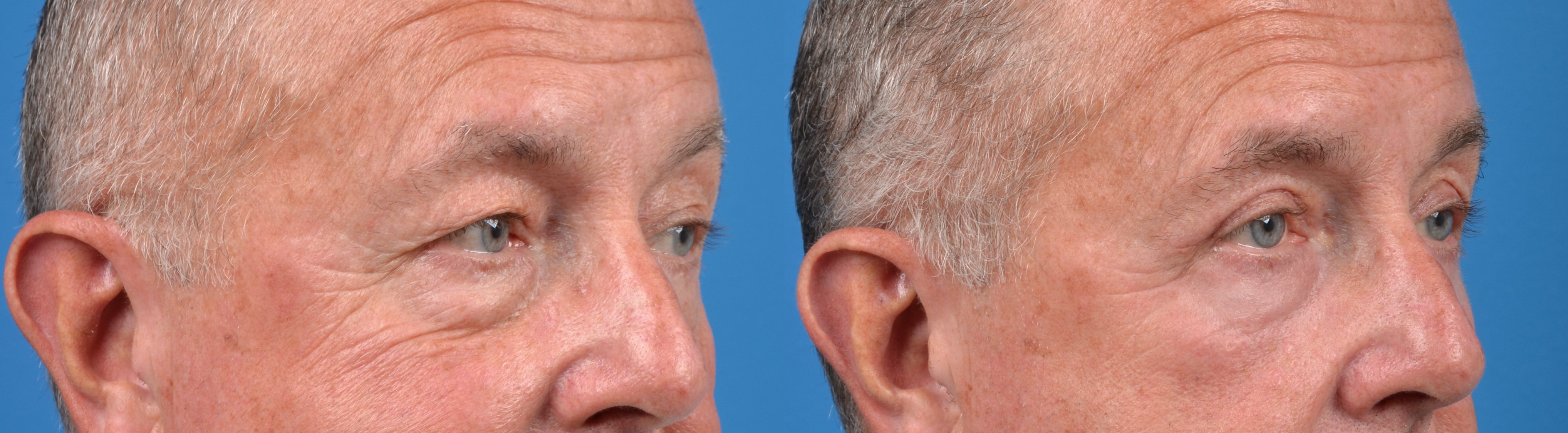 Eyelid Surgery Before & After Gallery - Patient 312219 - Image 3