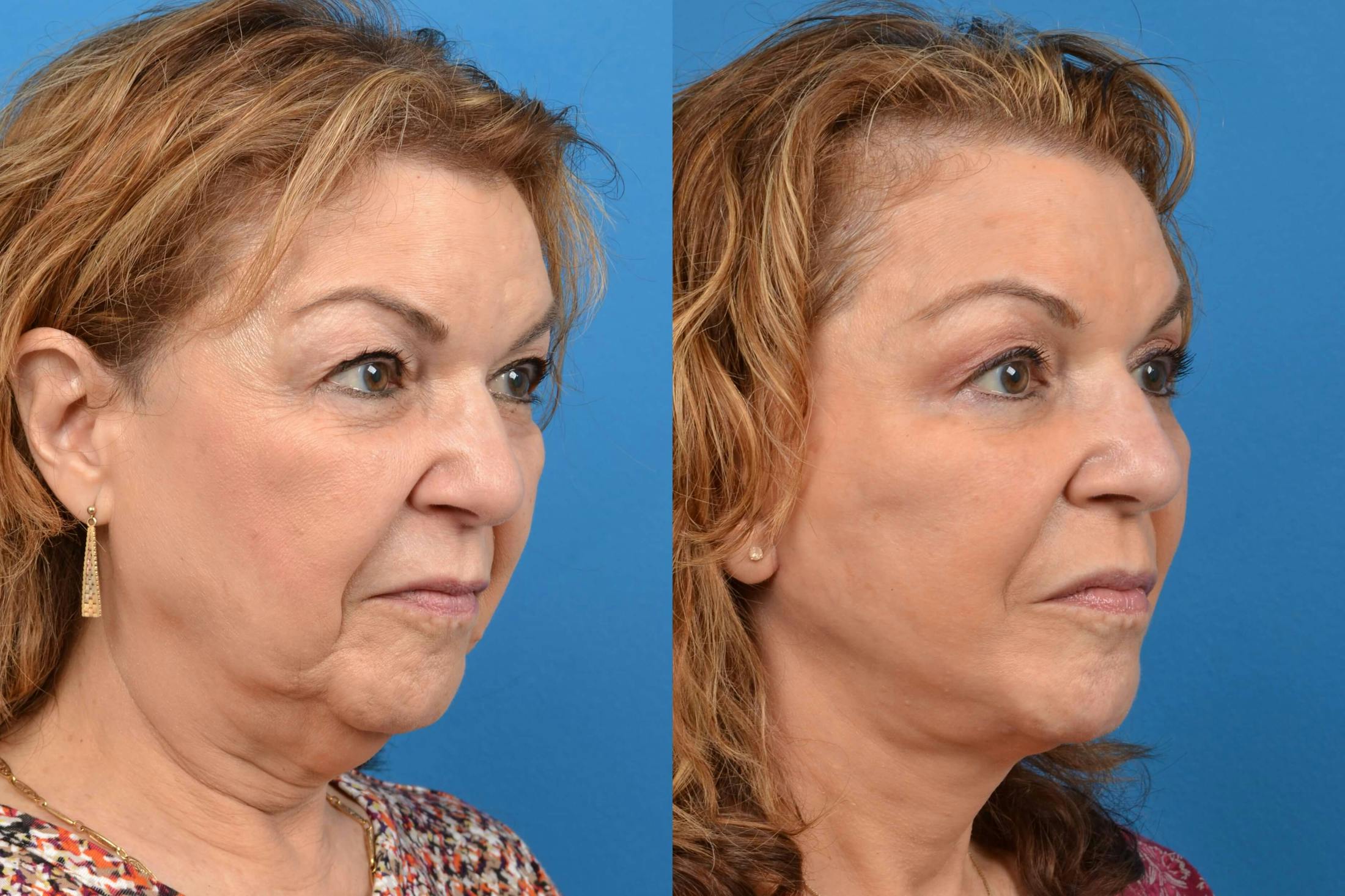 Facelift Before & After Gallery - Patient 122405713 - Image 4