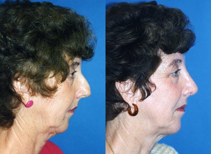 Facial Implant Before & After Gallery - Patient 122405710 - Image 1
